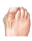 Palucha koślawego ortezy duży palec u nogi korektor stóp ulgę w bólu pielęgnacja stóp kości zespół cieśni kanału nadgarstka kore